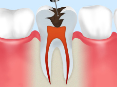 歯の神経を取るリスクについて