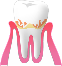 軽度の歯肉炎