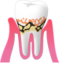 中度の歯周病